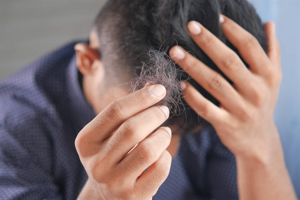 PRP hair restoration injection being administered to a patient's scalp in Cutler Bay, Florida